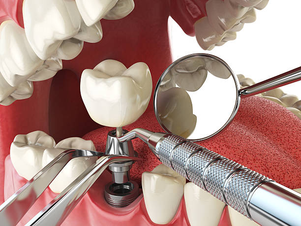 Best Emergency Root Canal Treatment in Nevada, MO